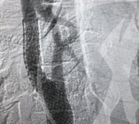 Imagem Angioplastia de carótida com implante de Stent