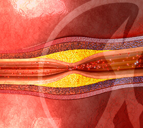 cardiologista-aterosclerose-thumb