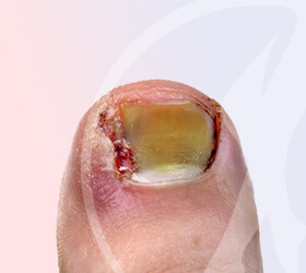 folino-gama-dematologia-cirurgico-unha-thumb