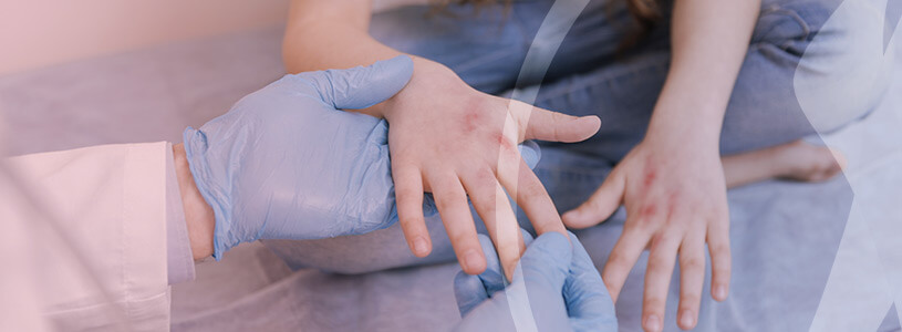 Dermatologia Eczemas
