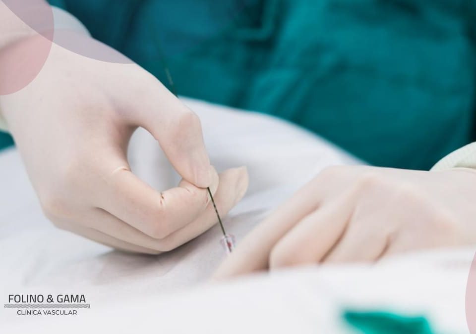 Cirurgia Endovascular
