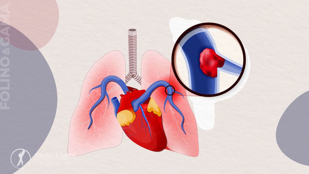 Embolia Pulmonar