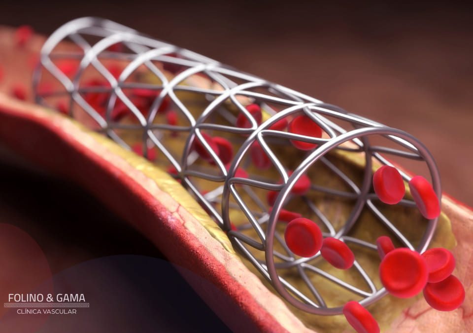 Colocacao De Stent