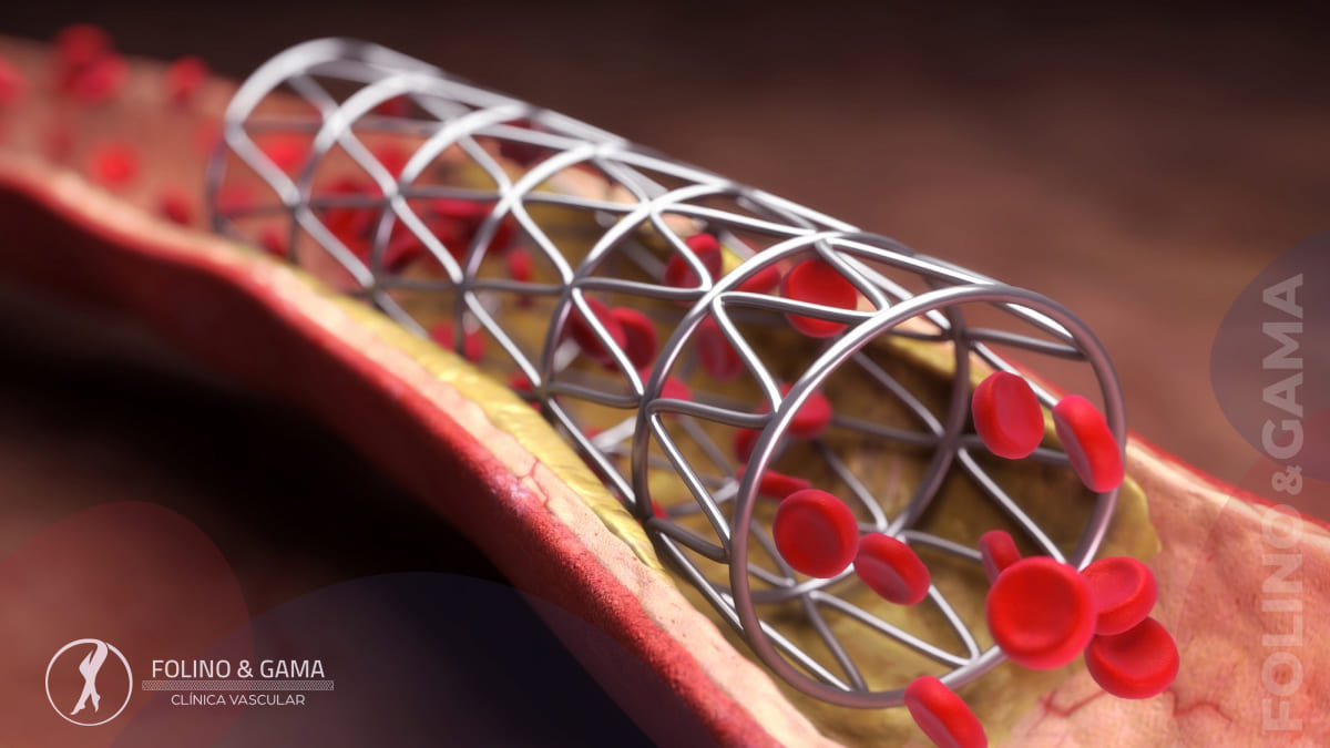 Colocacao De Stent