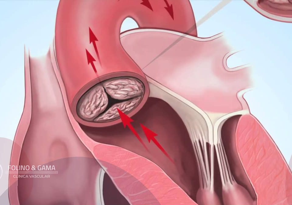 Estenose Aortica