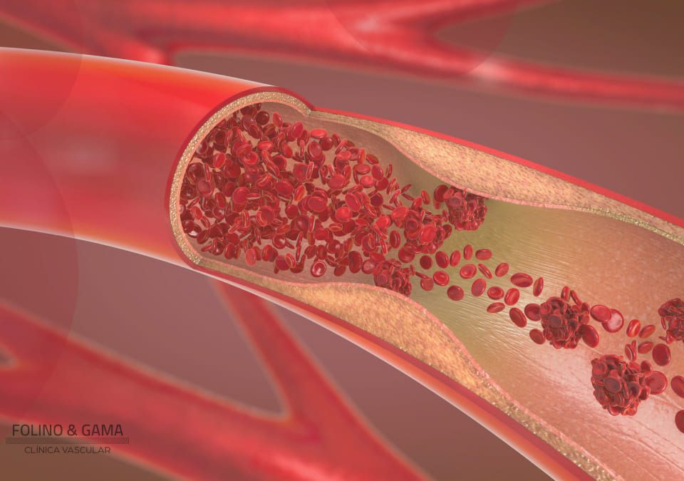 Principais Doencas Arteriais