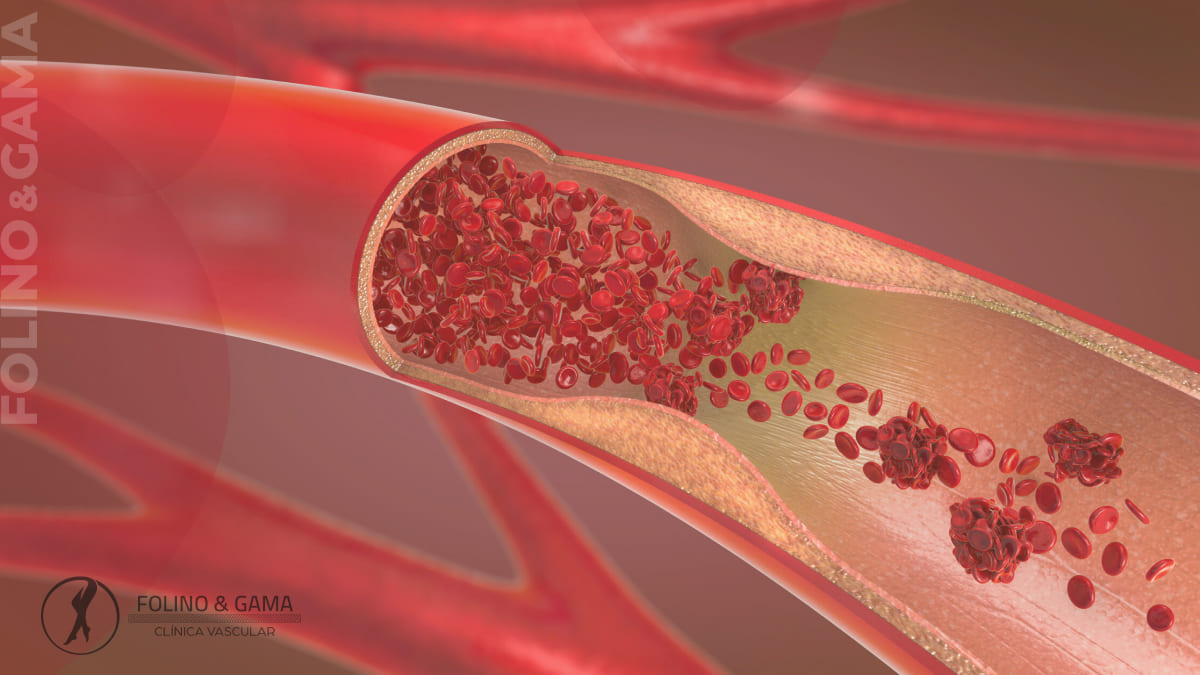 Principais Doencas Arteriais