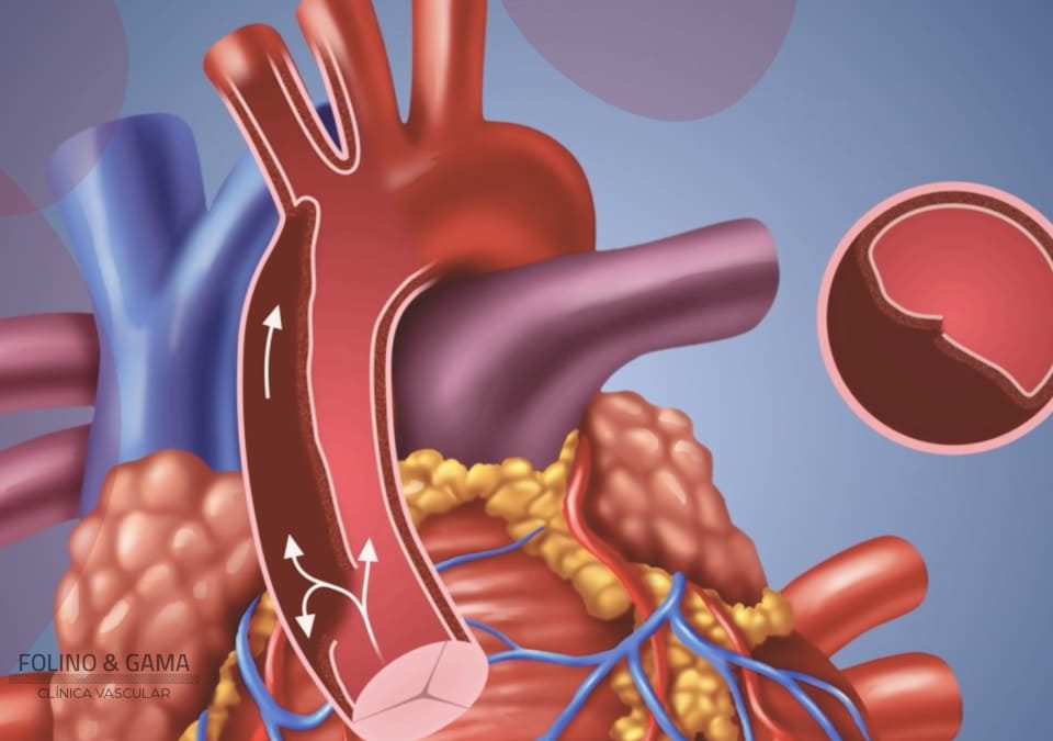 Disseccao De Aorta