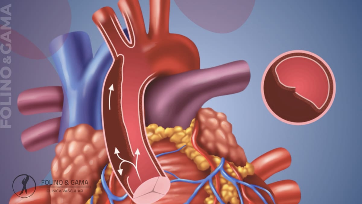 Disseccao De Aorta