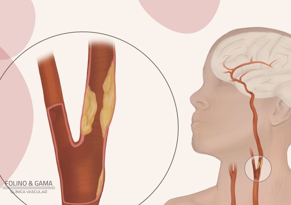 Obstrucao Da Carotida