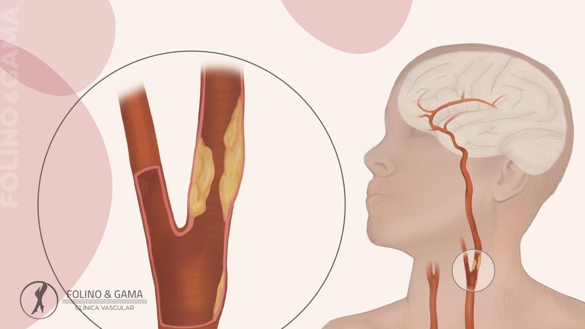 Obstrucao Da Carotida