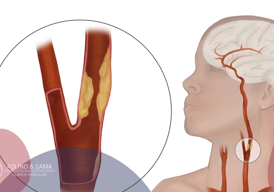 Doenca Das Carotidas