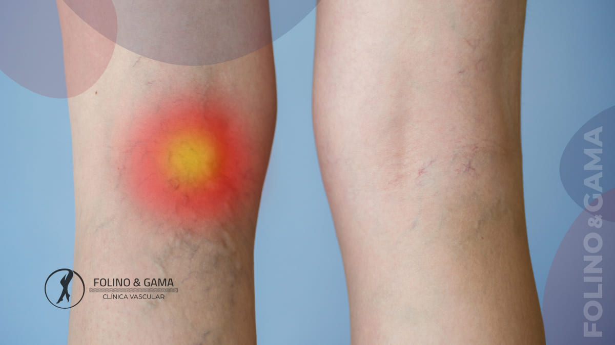 Inflamacao Nas Varizes
