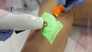 Tratamento A Laser Para Varizes E Vasinhos
