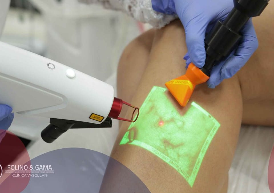 Tratamento Da Safena Com Laser